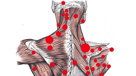 Trigger points in the muscles that provoke myofascial back pain