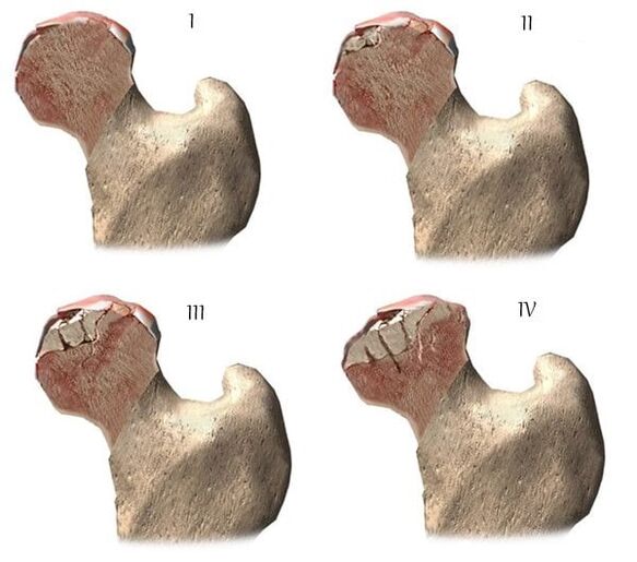 stages of osteoarthritis of the hip