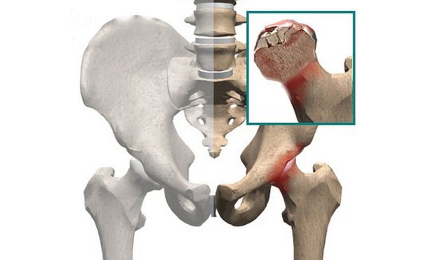 Necrosis of the femoral head is one of the causes of hip pain