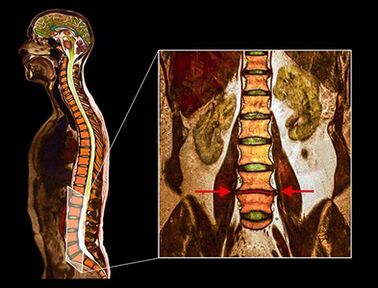 Degenerative disc in the spine