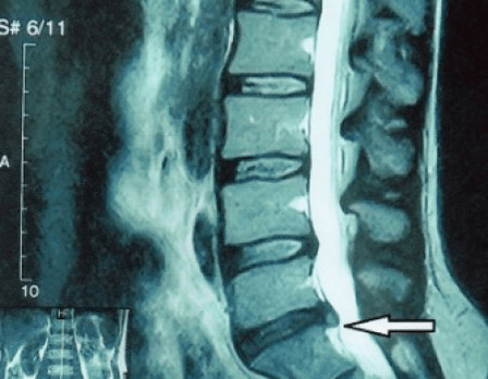 bulging of the spinal disc on an MRI scan