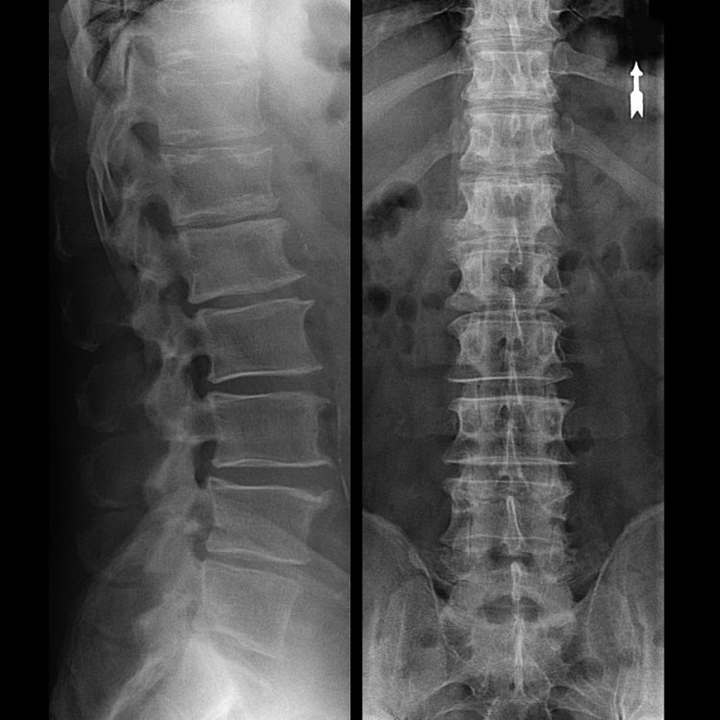 osteochondrosis of the spinal region on an X-ray