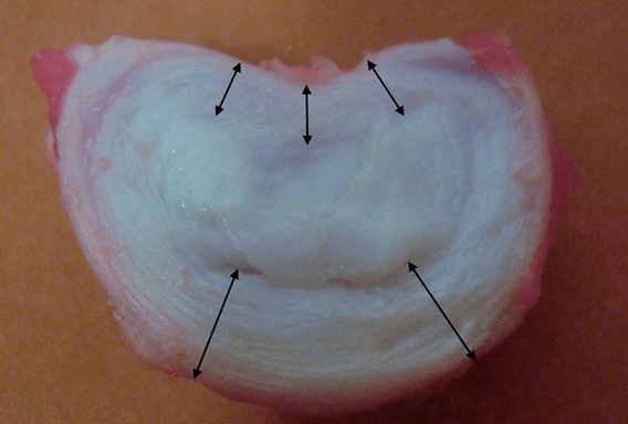 what does the intervertebral disc look like