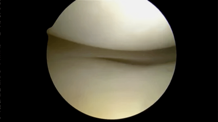 astroscope view of fully healthy surfaces