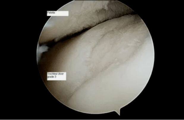 astroscopic view of a knee joint with 3rd degree osteoarthritis