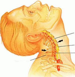 Osteochondrosis of the cervical vertebrae